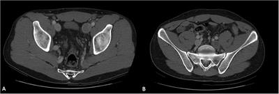 Case Report: Inferior Vena Cava Agenesia in a Young Male Patient Presenting With Bilateral Iliac Veins Thrombosis